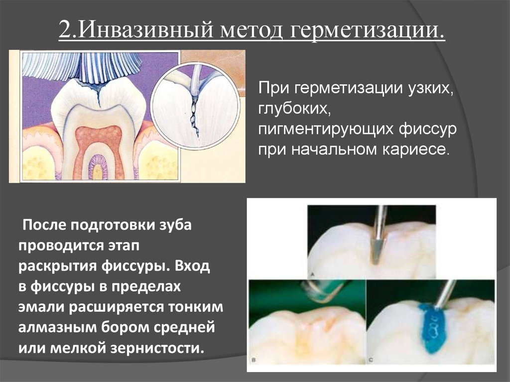 Изучение состояния зубов покрытых герметиком проводят по схеме