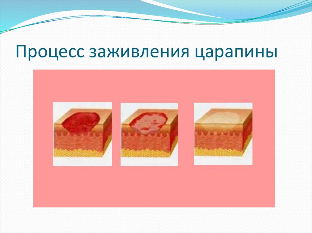 Заживление раны быстро. Процесс заживления царапины. Этапы заживления царапины. Процесс заживления ранки.