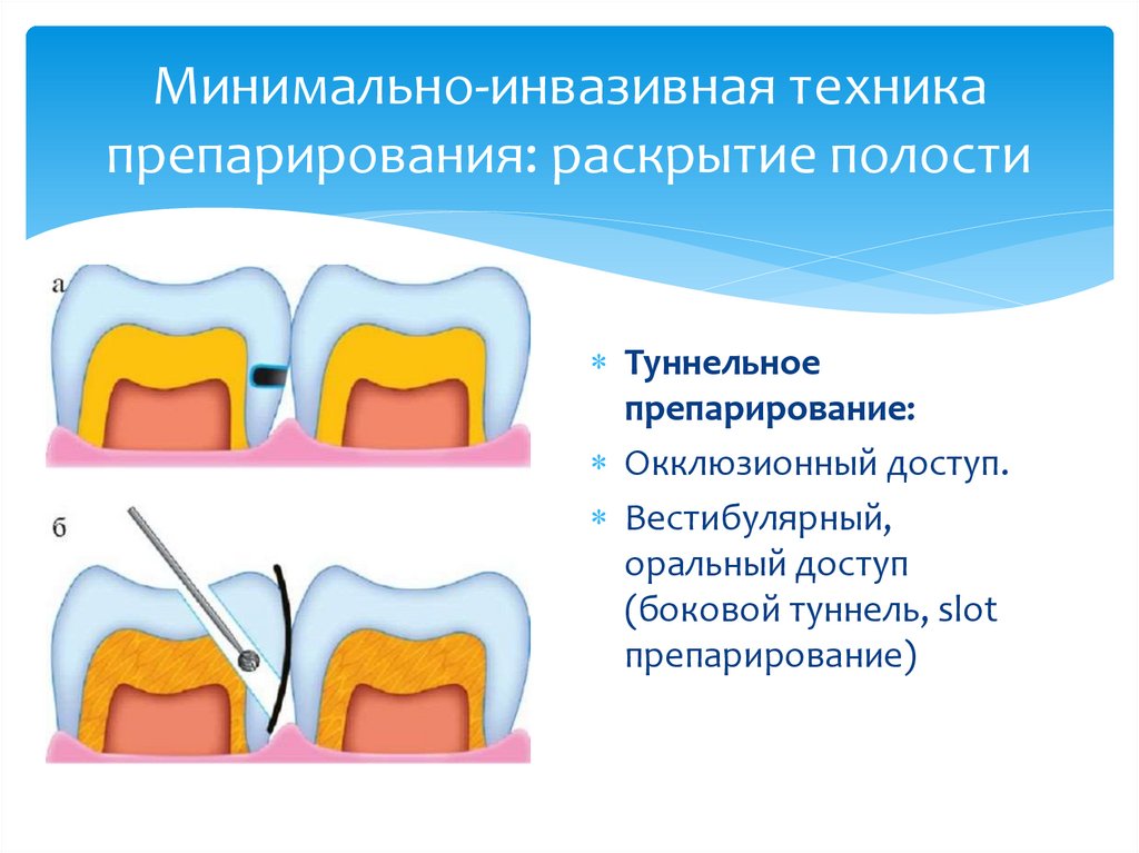 Классы препарирования по блэку