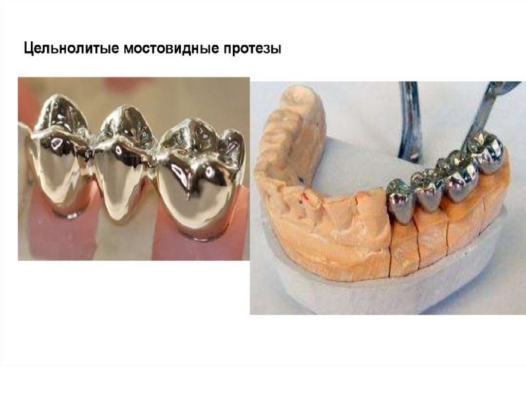 Штампованный протез. Штамповано-паяный мостовидный протез. Паяные мостовидные протезы презентация. Цельнолитая коронка. Цельнолитой мостовидный протез.