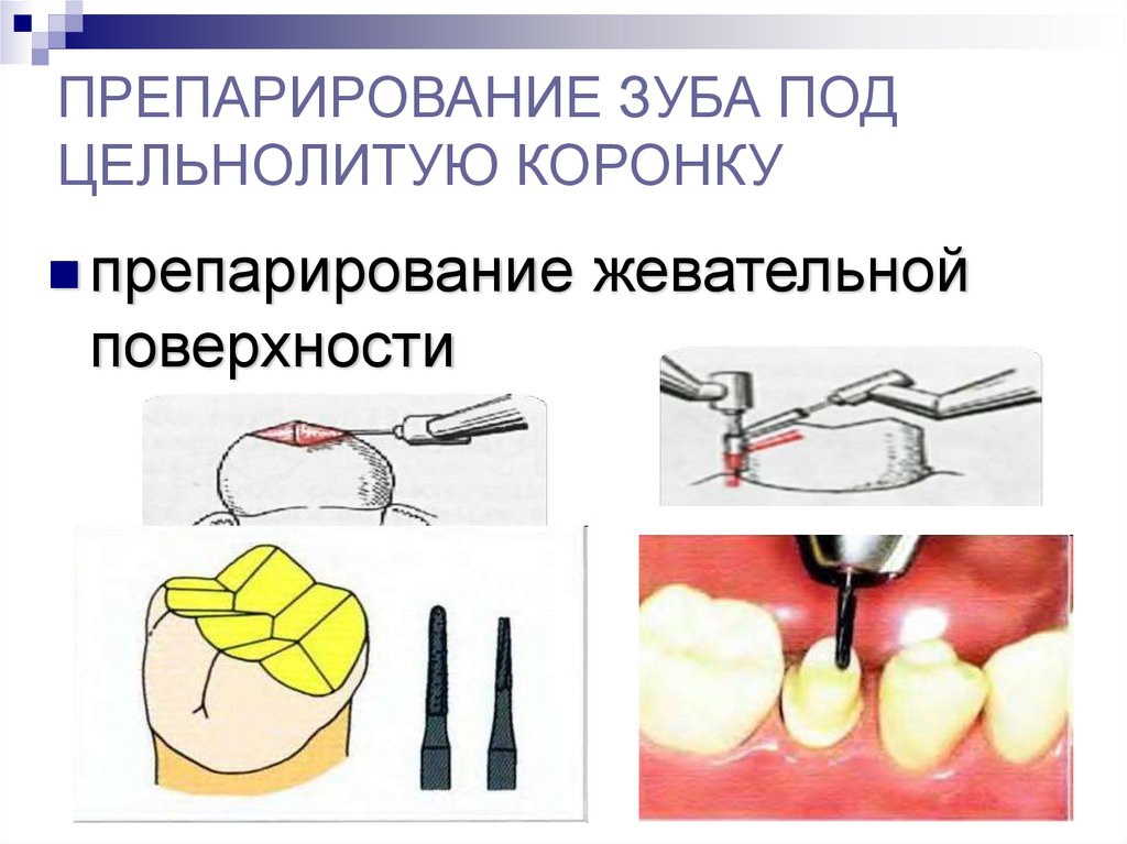 Препарирование зуба