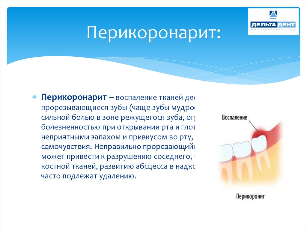 Полоскать содой после удаления зуба. Перикоронарит воспаление. Перикоронарит зуба мудрости.