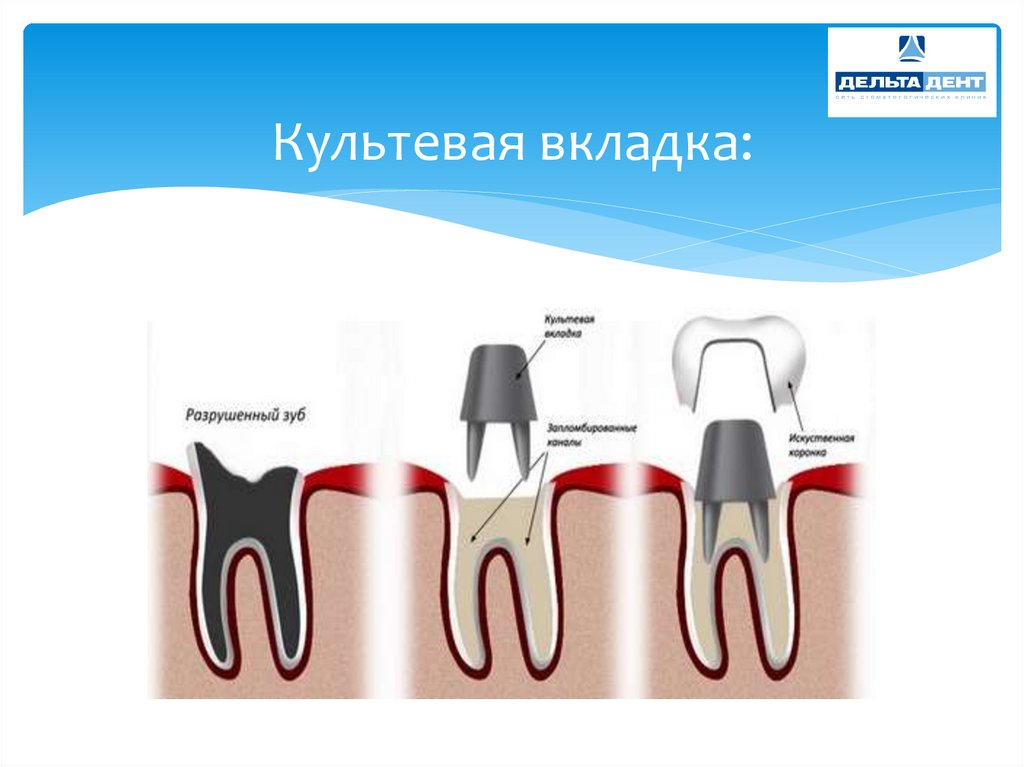 Культевая вкладка схема