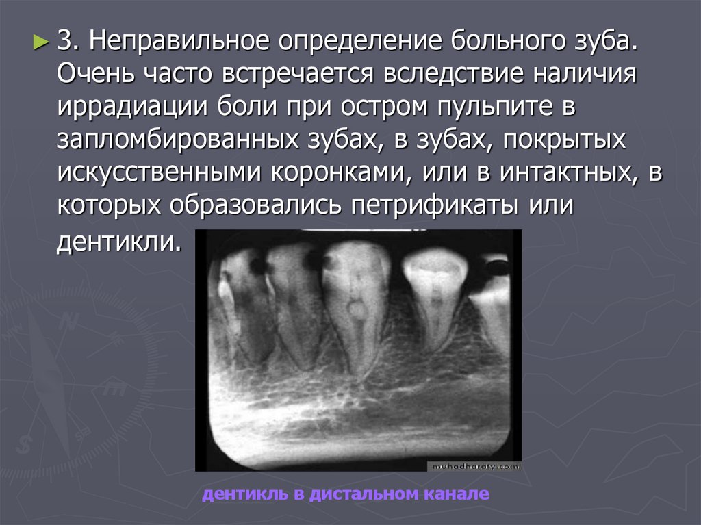 Неправильное определение. Пульпит рентген описание. Видно ли на рентгене пульпит зуба. Осложнения хронического пульпита.