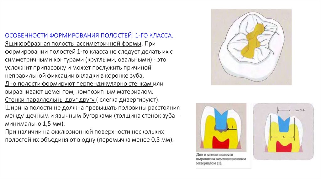 Форма кариозной полости. Основные принципы препарирования полостей под вкладку. Основные принципы препарирования кариозных полостей по Блэку. Требования предъявляемые к сформированной кариозной полости. Препарирование полостей 1 класса по Блэку.