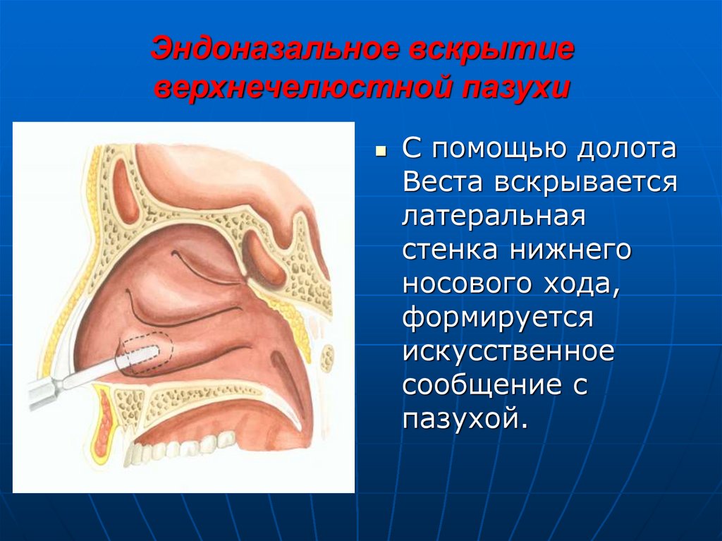 Гиперплазия слизистой верхнечелюстной. Синусотомия верхнечелюстной пазухи. Латеральная верхнечелюстной пазухи это. Латеральная стенка гайморовой пазухи. Выводной проток гайморовой пазухи.