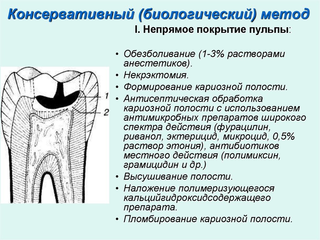 Схема лечения пульпита