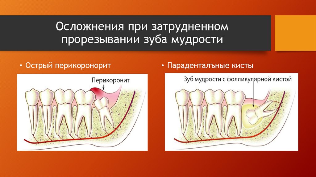 Периостит классификация