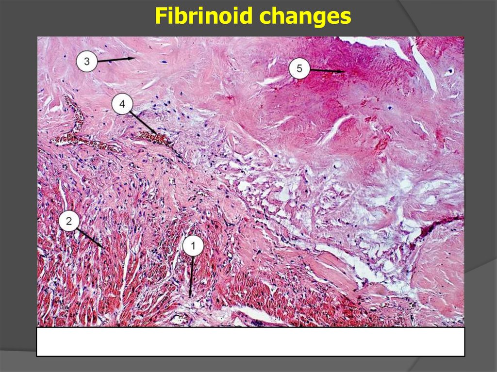 Кардиосклероз рисунок микропрепарат