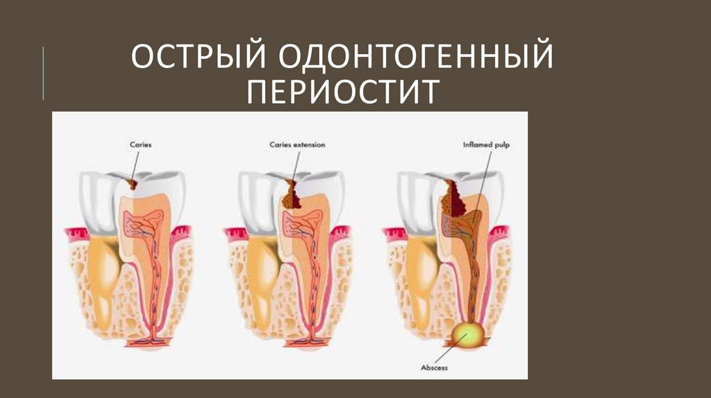 Одонтогенные осложнения. Острый одонтогенный периостит. Острый одонтогенный периостит челюстей. Одонтоген периостит. Одонтогенный абсцесс зуба.