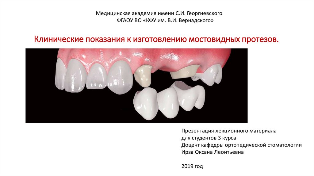 Мостовидные протезы этапы. Мостовидные коронки показания. Мостовидные протезы ортопедическая стоматология презентация. Показания к изготовлению мостовидных протезов. Литой мостовидный протез показания.