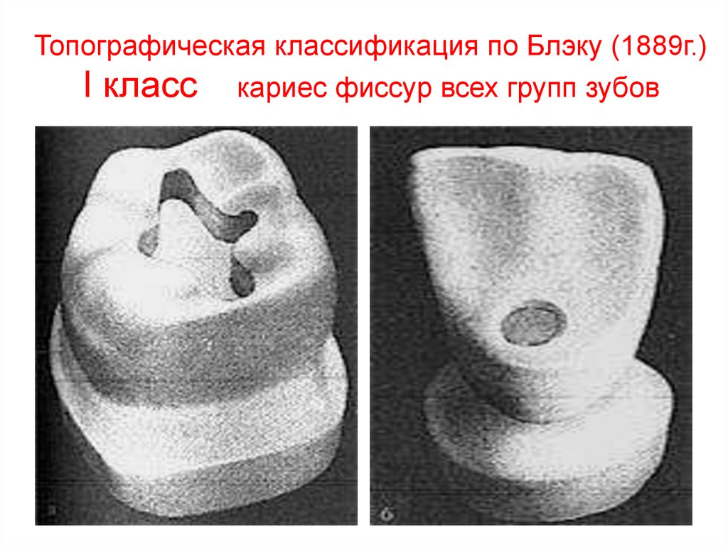 Сколько лет блэку. Классификация кариозных полостей Блэка. Кариозные полости 6 класса по Блэку. Кариес зубов классификация кариозных полостей по Блэку. Кариозная полость 1 класса по Блэку.