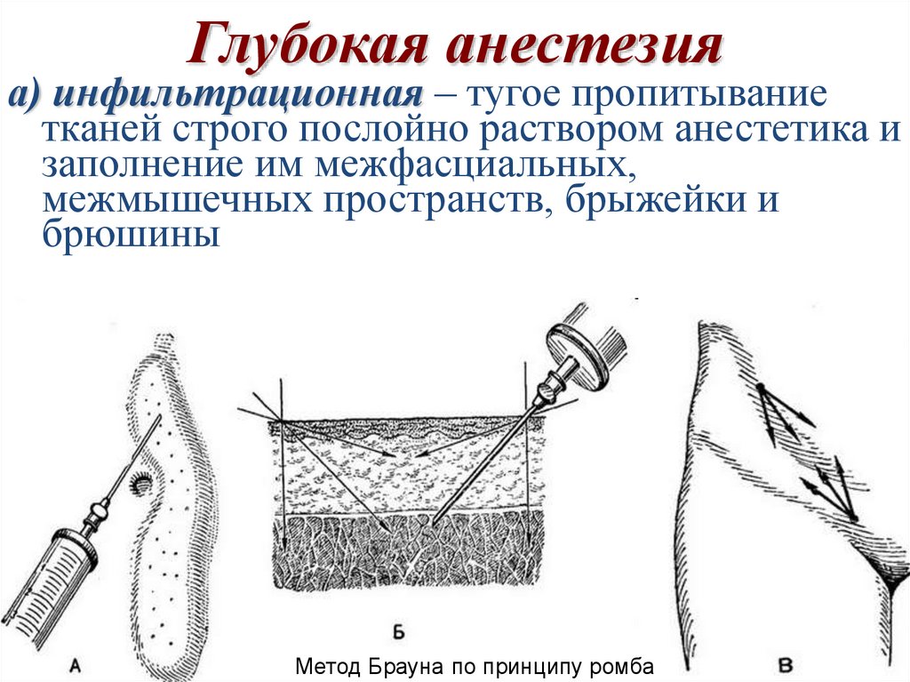 Что такое местная анестезия при операции