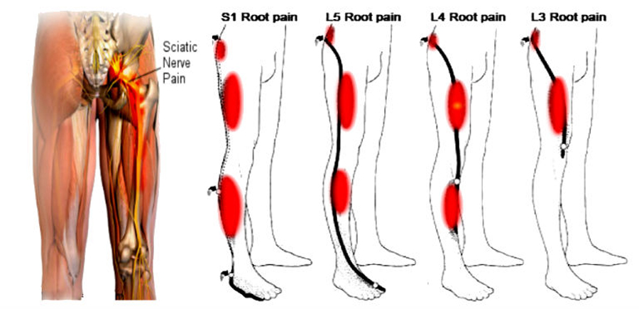 Сильно болят ноги форум. Седалищный нерв в икроножной мышце. Седалищный нерв л5 с1. Триггерные точки икроножной мышцы. Седалищный нерв на голени.