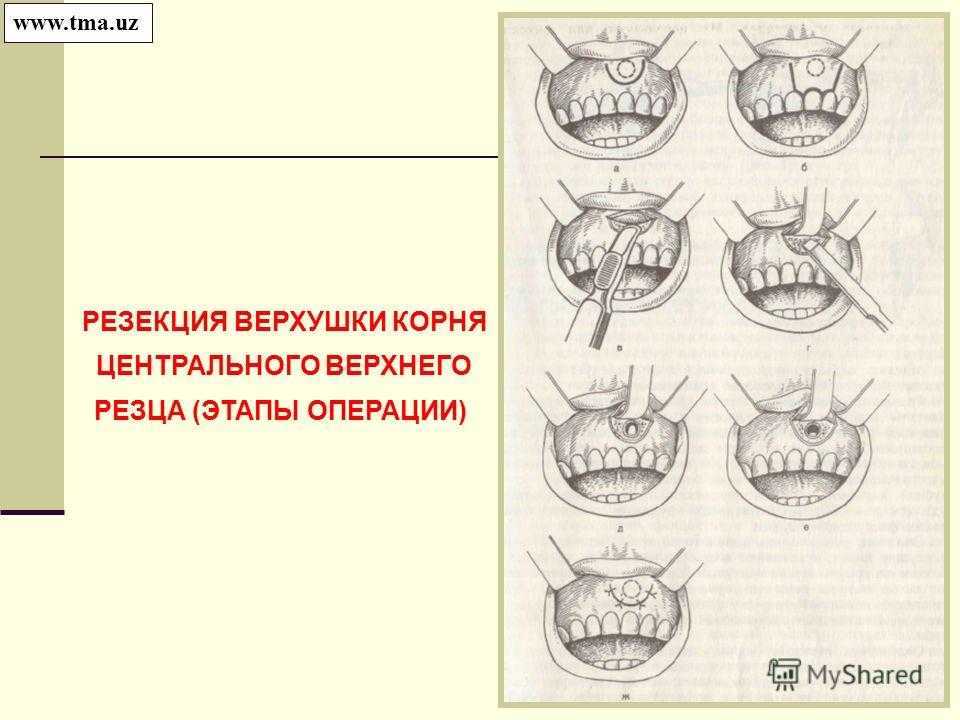 Что такое резекция зуба. Методика проведения операции резекции верхушки корня зуба. Операция цистэктомия с резекцией верхушки корня. Резекция верхушки корня однокорневого зуба. Резекция верхушки корня этапы операции.