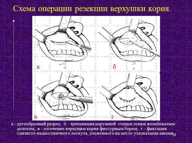 Лоскут зубы. Методика проведения операции резекции верхушки корня зуба. Резекция верхушки корня этапы операции. Операция резекции верхушки корня зуба. Резекция верхушки корня схема.