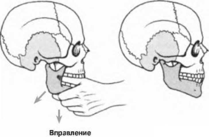 Клиническая картина вывиха нижней челюсти