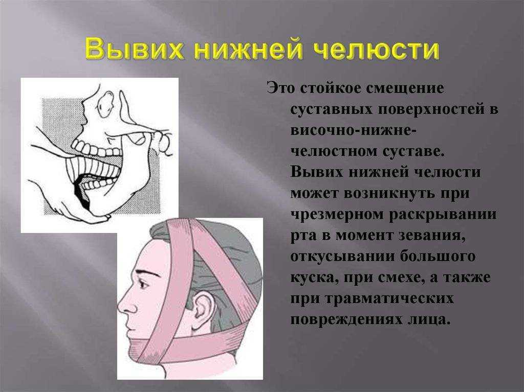 Что делает нижний. Клинические симптомы вывиха нижней челюсти. Вивыхи нижней челюстей. Односторонний вывих нижней челюсти. Односторонний вывих челюсти.