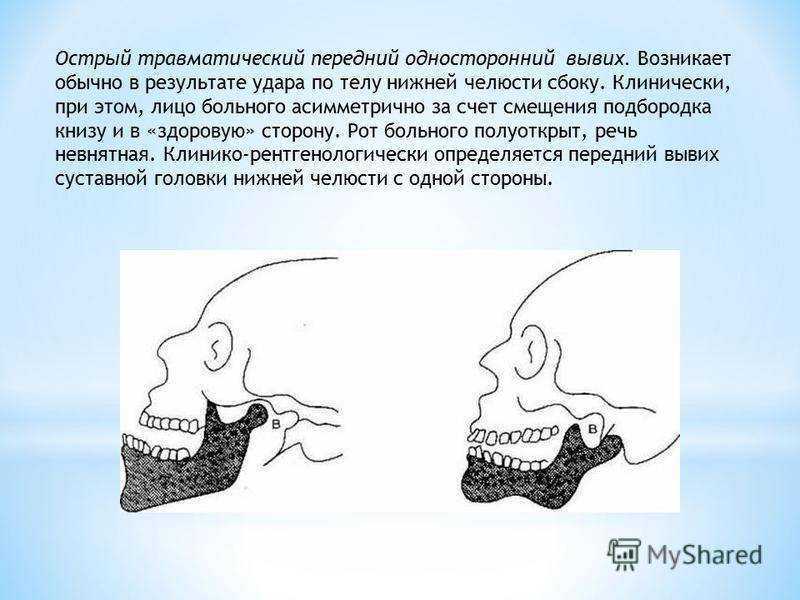 Вывих нижней челюсти. Передний односторонний вывих нижней челюсти. Односторонний вывих челюсти. Вправление переднего вывиха нижней челюсти. Передний вывихнижнец челюсти.