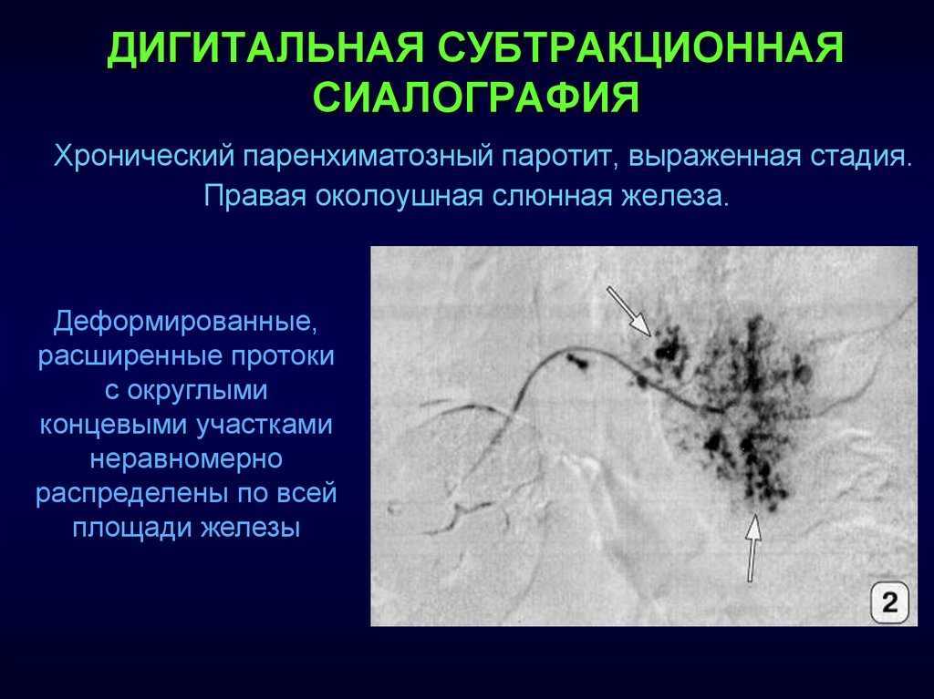 Паротит хронический. Хронический паренхиматозный паротит. Контрастная сиалография. Сиалограмма слюнных желез.