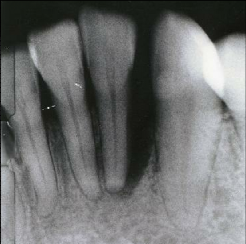 Пародонтит рентгенологическая картина