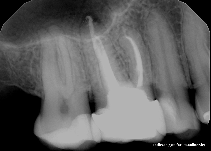 Рентгеновский Снимок Зуба Фото