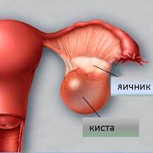 Где у девушки яичники. Кубовидная киста яичника. Апоплексия левого яичника. Яичники у женщин.