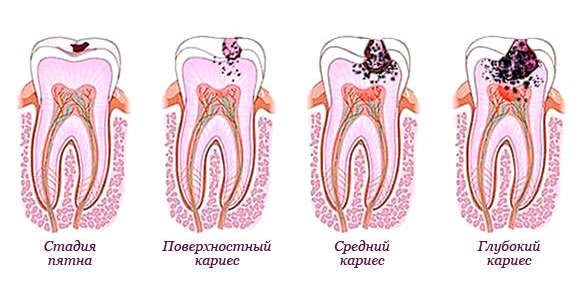 Клиническая картина кариеса