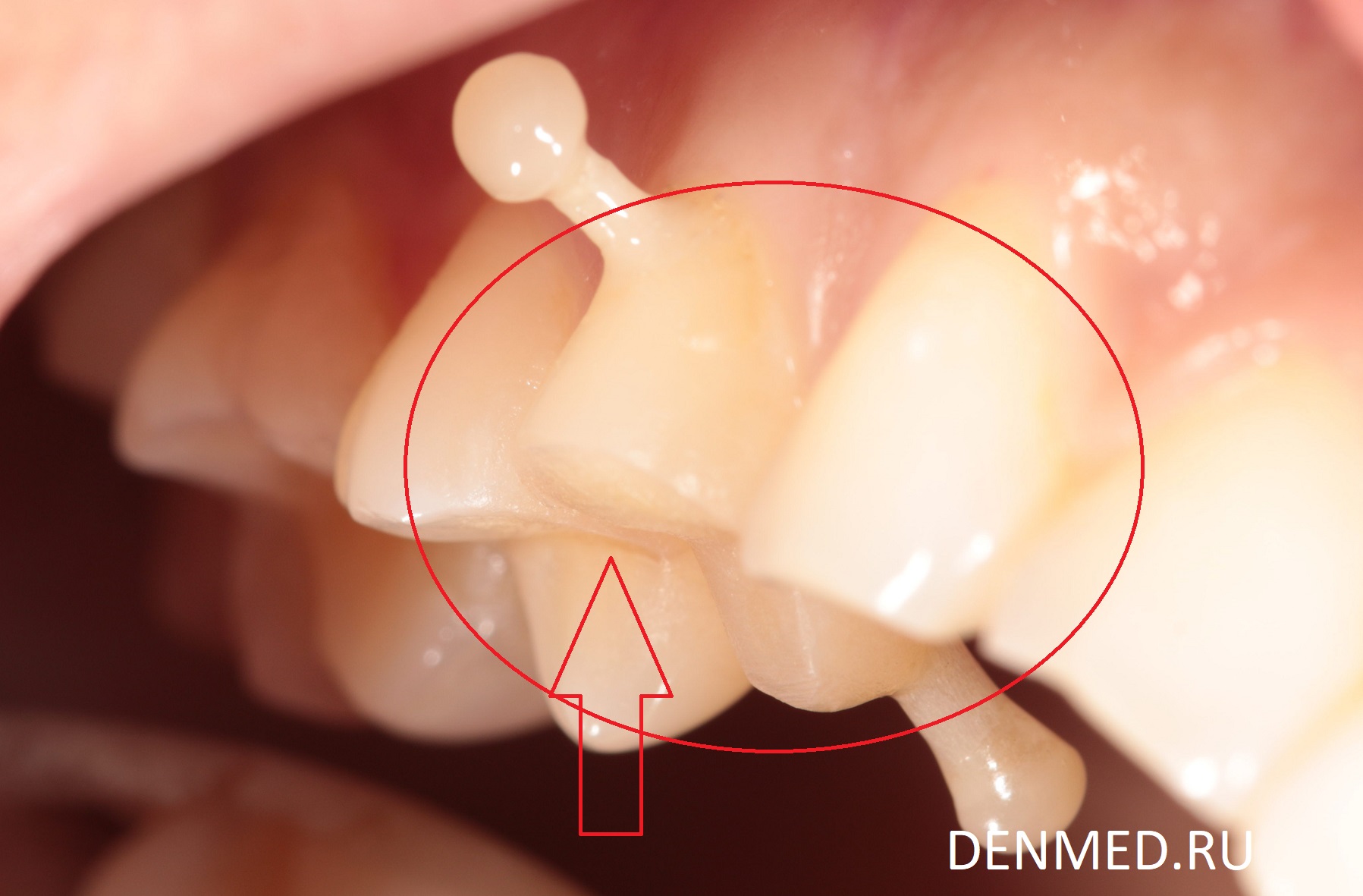 Этапы перемещения зуба, в промежуточных визитах в клинику ДенМед