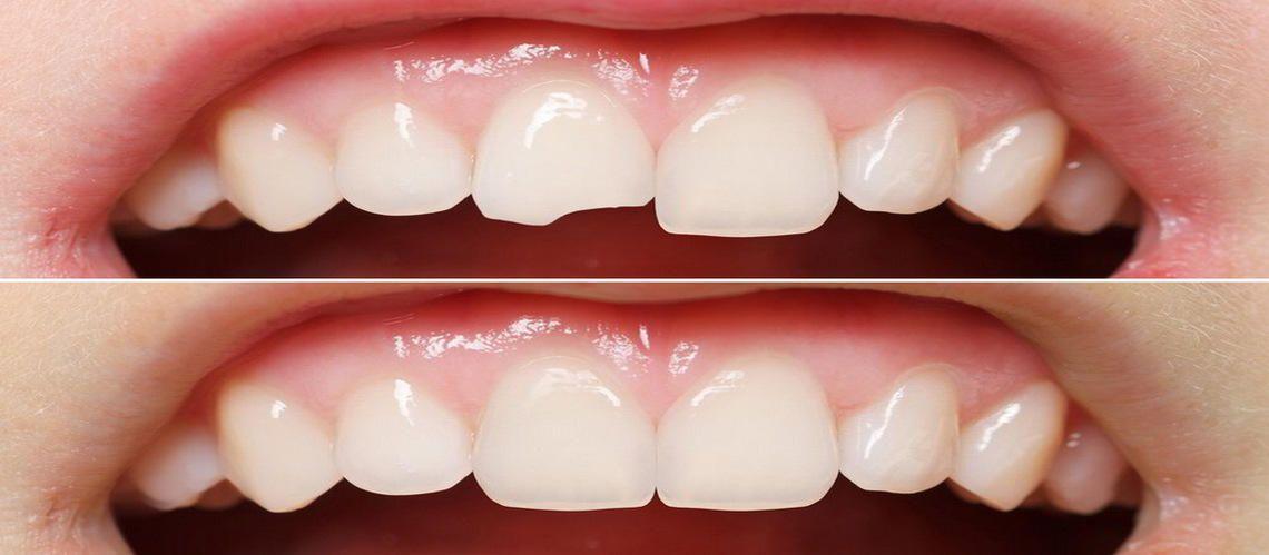 Зубная реставрация. Восстановление передних зубов. Наращивание зубов композитными материалами. Восстановление передних зубов пломбой.