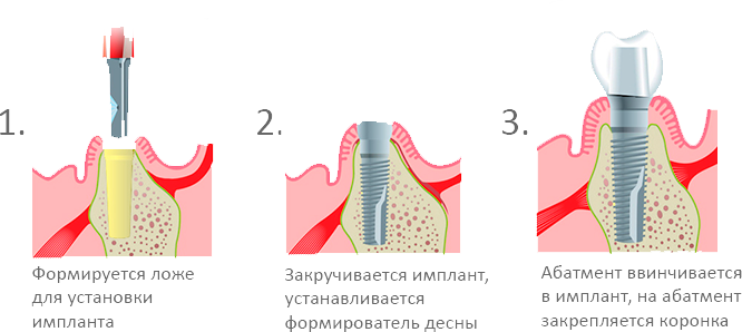 Сколько отходит анестезия после зуба. Установка формирователя десны методика. Абатмент в стоматологии. Зазор между имплантом и абатментом.