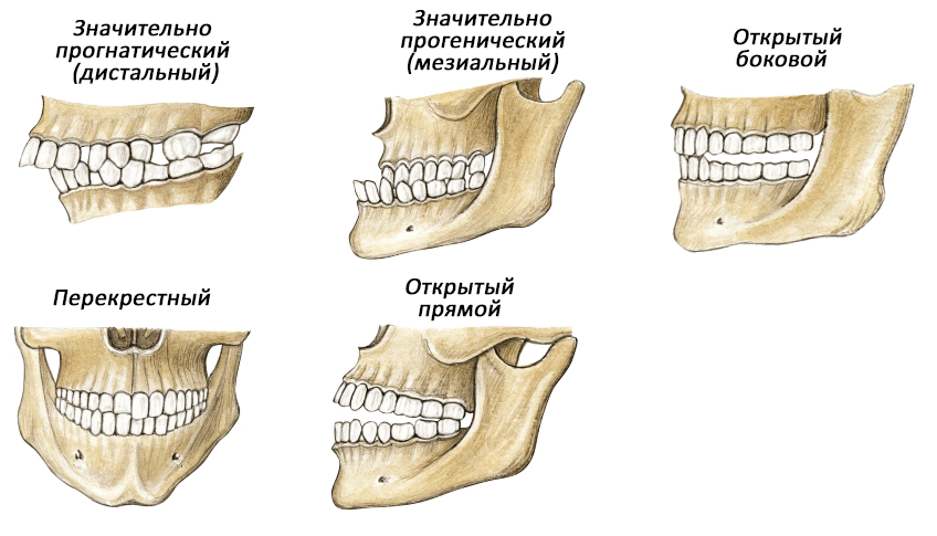 Три пары челюстей. Дистальный прикус (прогнатический прикус). 171. Патологические прикусы. Перекрестный прикус.. Передний дистальный открытый прикус. Аномалии прикуса прогнатия.