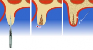 Этапы процедуры расщепления альвеолярного отростка челюсти