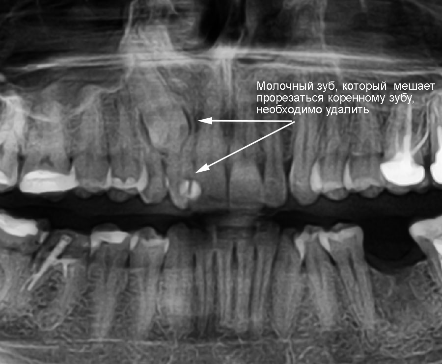  Молочный зуб мешает прорезыванию коренного.