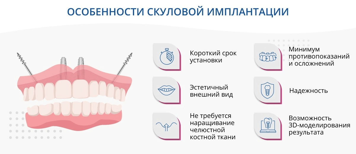 Противопоказания для имплантов. Скуловая имплантация зубов. Метод базальной имплантации. Минусы имплантации зубов.