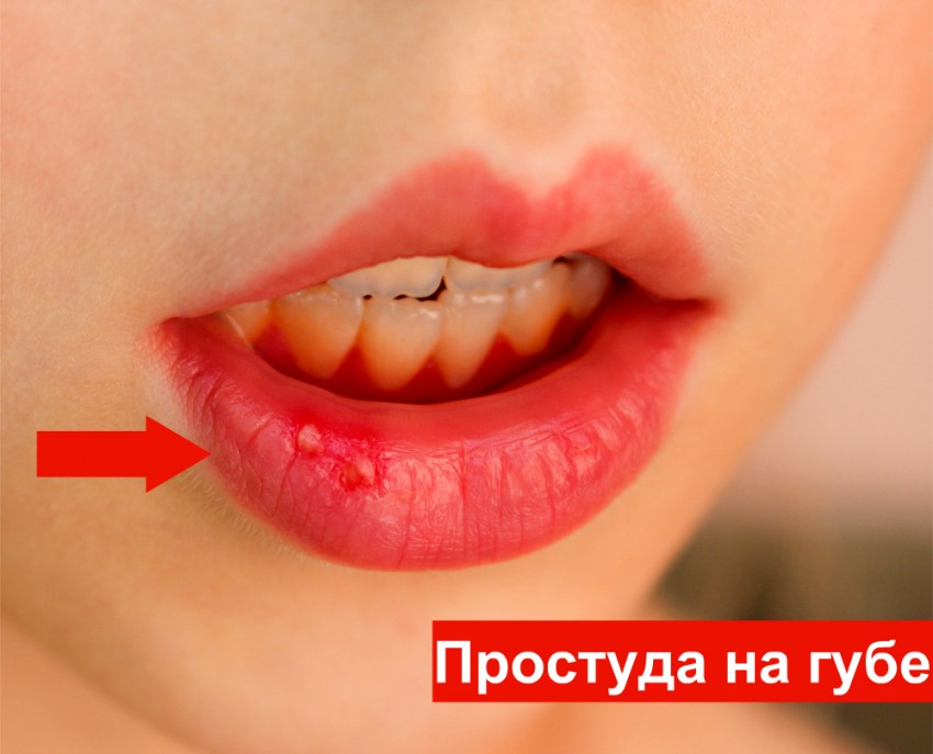 Как выглядит рак губы начальная стадия фото