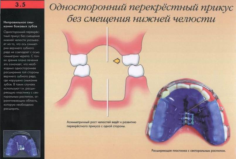 Перекрестный прикус схема лечения у взрослого
