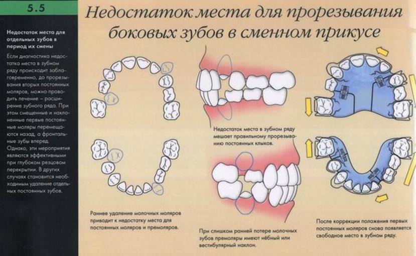 Как долго растут зубы мудрости. Открытый прикус молочные зубы. Сменный и постоянный прикус. Группы зубов в Молочном прикусе.