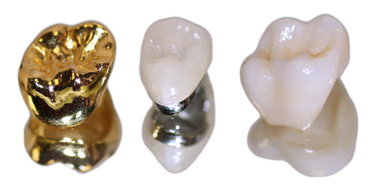 Коронки из каких материалов бывают. Металлическая коронка на зуб. Одиночные зубные коронки. Коронка металлокерамика.