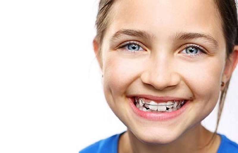 Брекеты на зубы для детей сколько стоят. Детские брекеты. Металлические брекеты детям. Красивые детские брекеты.