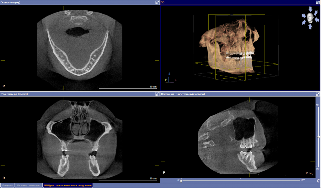 Компьютерно лучевая томография. КЛКТ 23х17. Компьютерная томография зубов Пикассо. Кт нижней челюсти Пикассо.