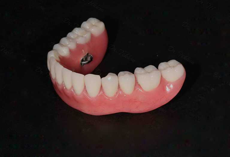 Фото протезирование протез нижних зубов виды какой лучше