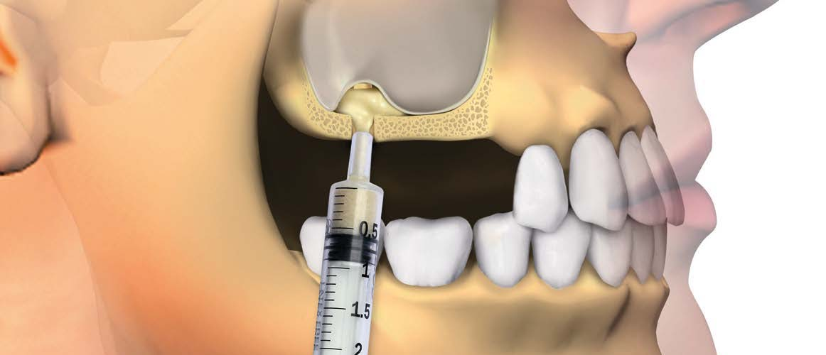 Восстановление костной ткани зубов. Синус-лифтинг (костная пластика, остеопластика). Синус-лифтинг (Bio-oss 1 грамм). Синус лифтинг верхней челюсти. Синус-лифтинг (костная пластика, остеопластика) закрытый.