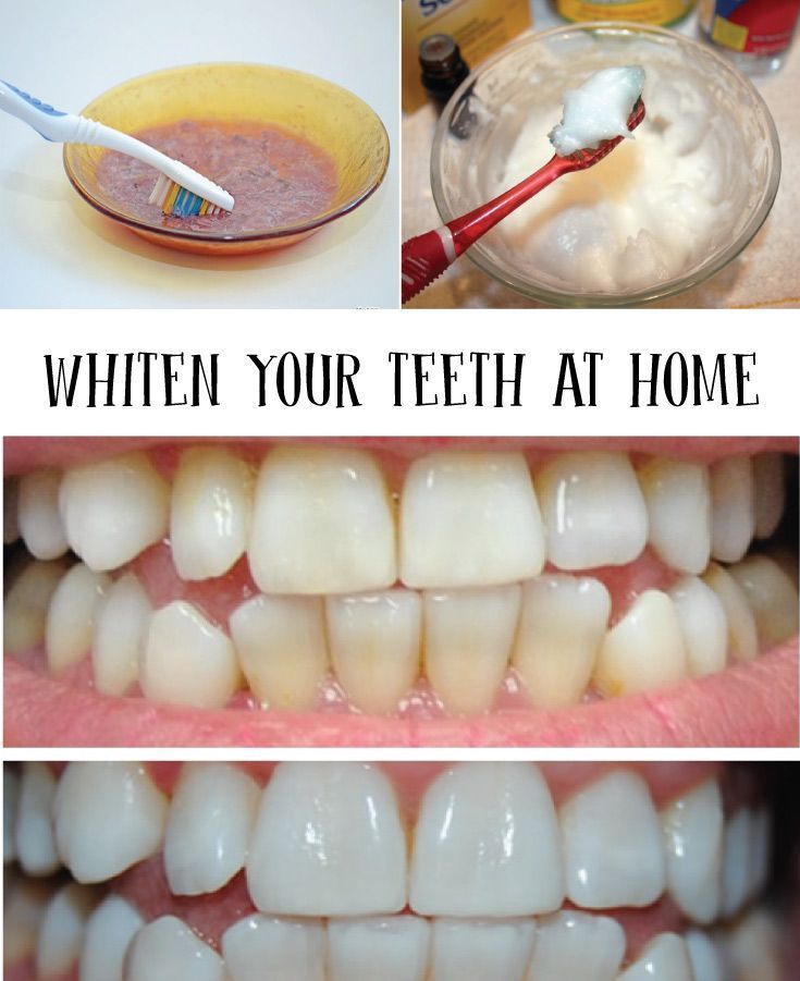 Как можно отбелить зубы в домашних условиях. Отбеливание зубов в домашних условиях. Отбеливание своих зубов.