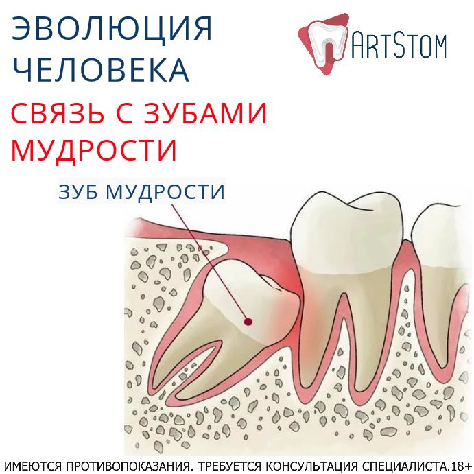 Зуб мудрости схема