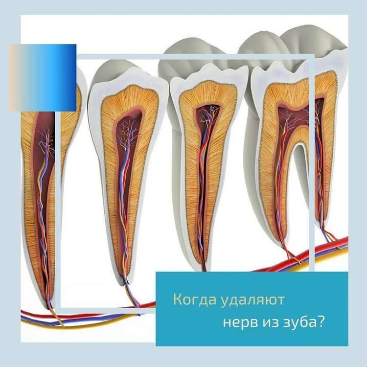 Удаленный нерв зуба. Строение пульпы зуба.