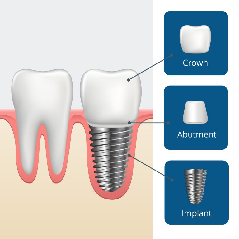 Стоматологические импланты отзывы. 3101 0208 Dental Implants наклейка. Зубной имплантат. Абатмент.