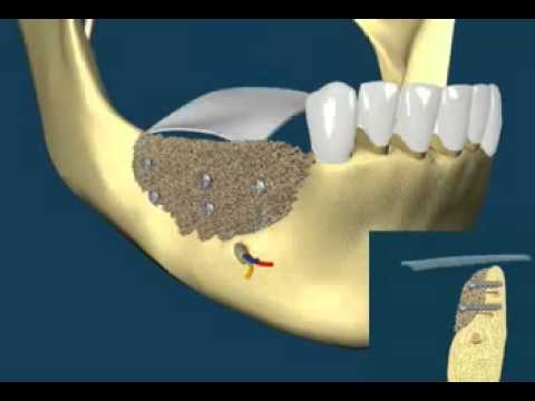 Восстановление костной ткани зубов. Костная пластика (остеопластика). Аугментация альвеолярного отростка. Остеопластика альвеолярного отростка. Костная пластика альвеолярного отростка.