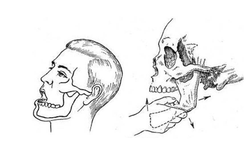 Не открывается рот челюсть. Схему вправления вывиха нижней челюсти. Вывих височно-нижнечелюстного сочленения (вывих нижней челюсти).