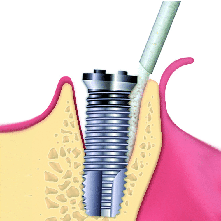 Имплант наращивание. Синус-лифтинг (костная пластика, остеопластика). Putty OSTEOBIOL. Мембрана коллагеновая OSSGUIDE TG-1. Открытый синус лифтинг инструменты.